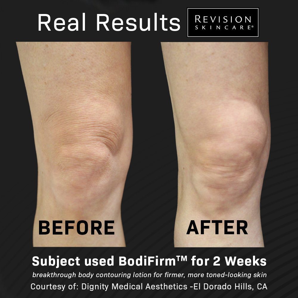 revision bodiform contouring lotion rejuv medical